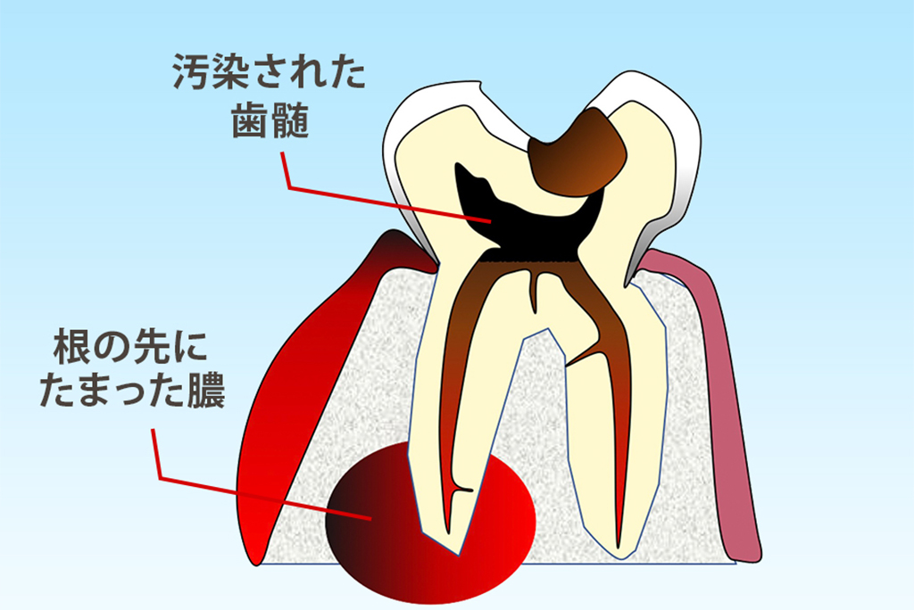 可逆性歯髄炎